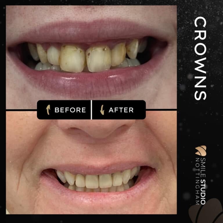 Dental crowns before and after at Smile Studio Dentist in Arnold Nottingham
