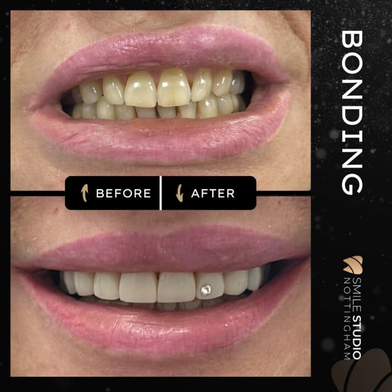 Composite bonding before and after at Smile Studio Dentist in Arnold Nottingham