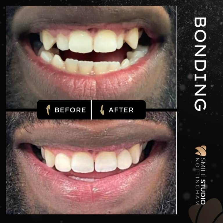 Composite bonding before and after at Smile Studio Dentist in Arnold Nottingham