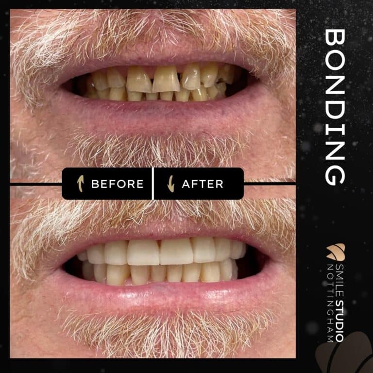 composite bonding before and after