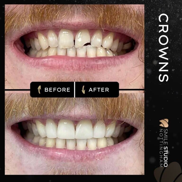 crowns before and after