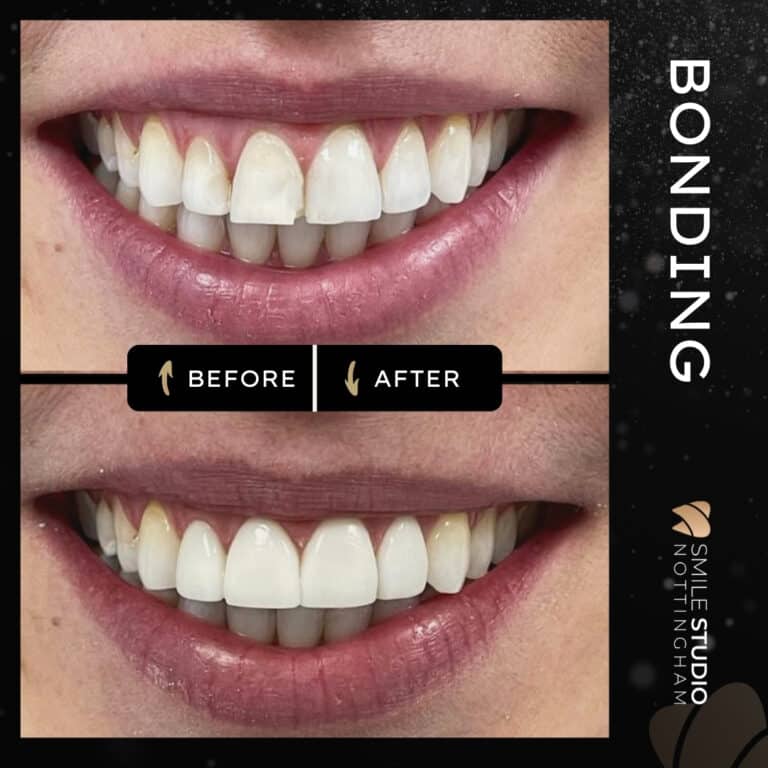 Composite bonding before and after at Smile Studio Dentist in Arnold Nottingham