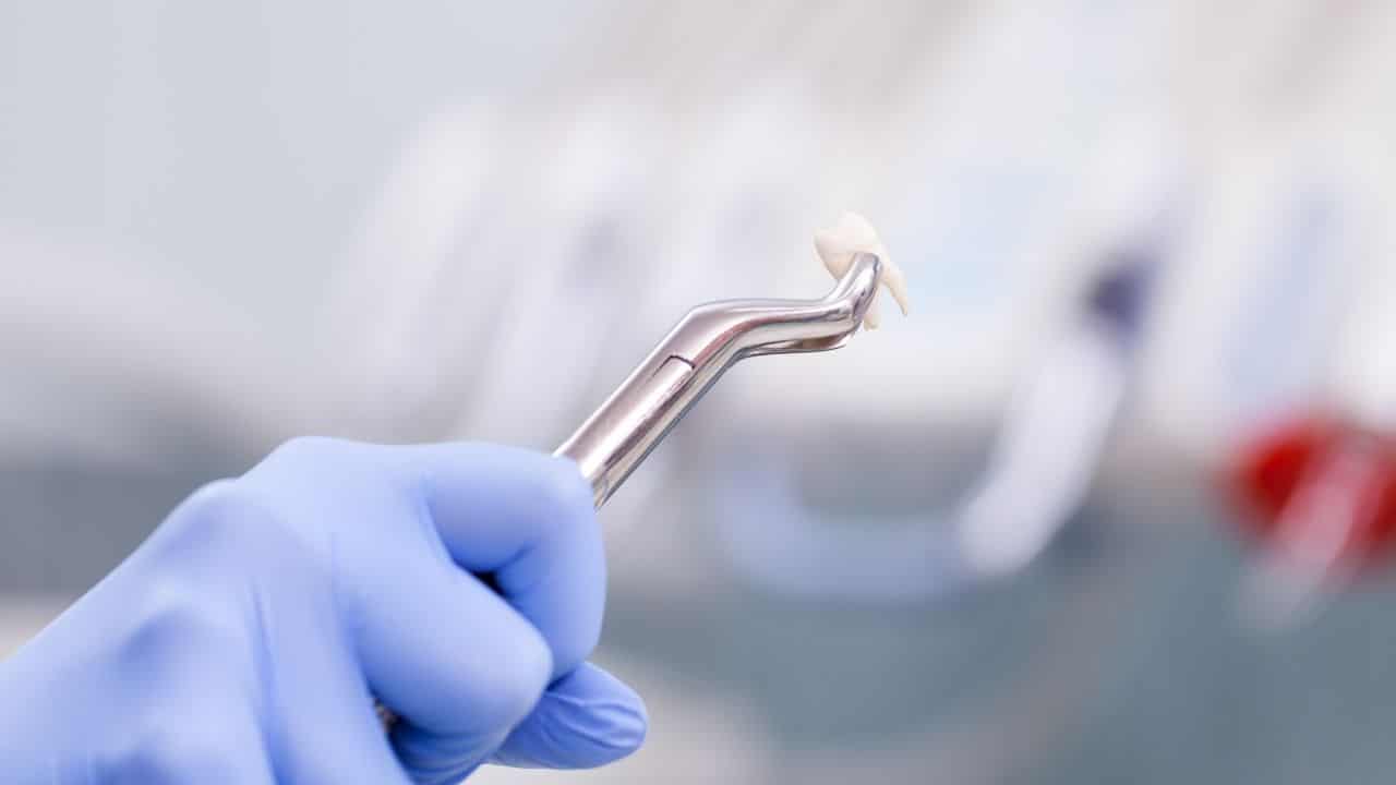 tooth extraction in nottingham