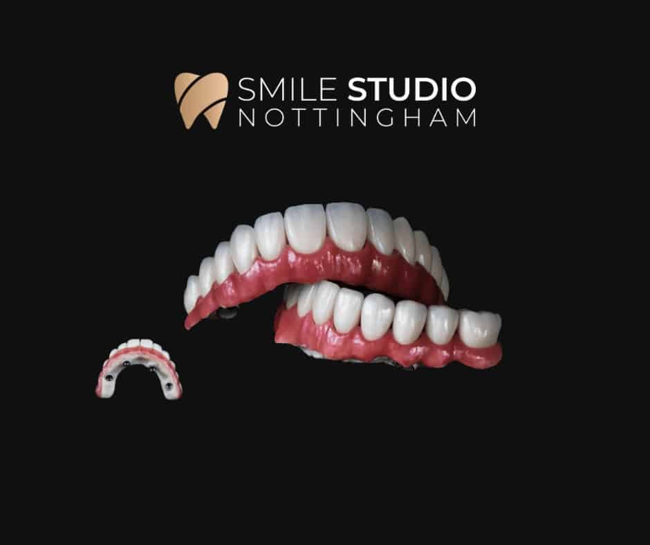 all on 6 dental implants in nottingham