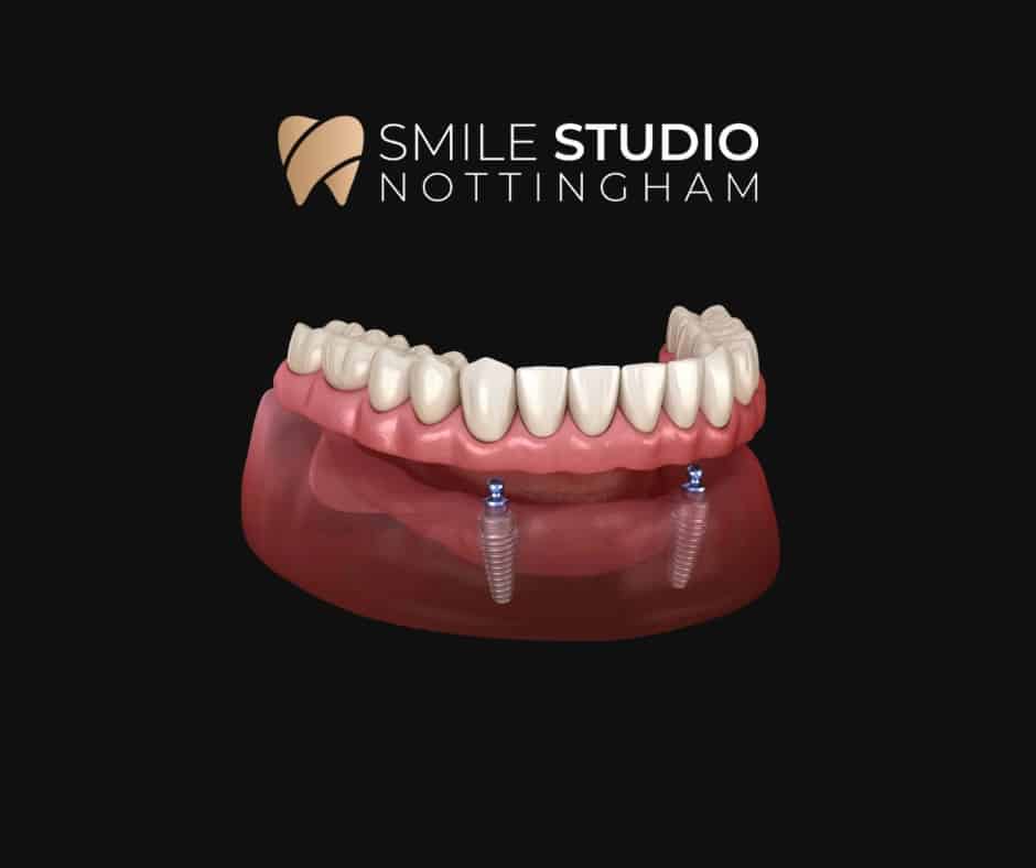 implant retained denture in nottingham