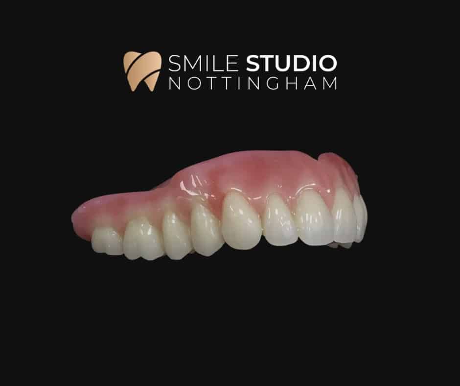 Implant-Retained Dentures