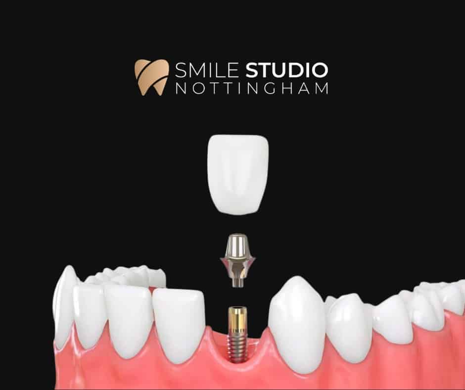 single dental implant crown