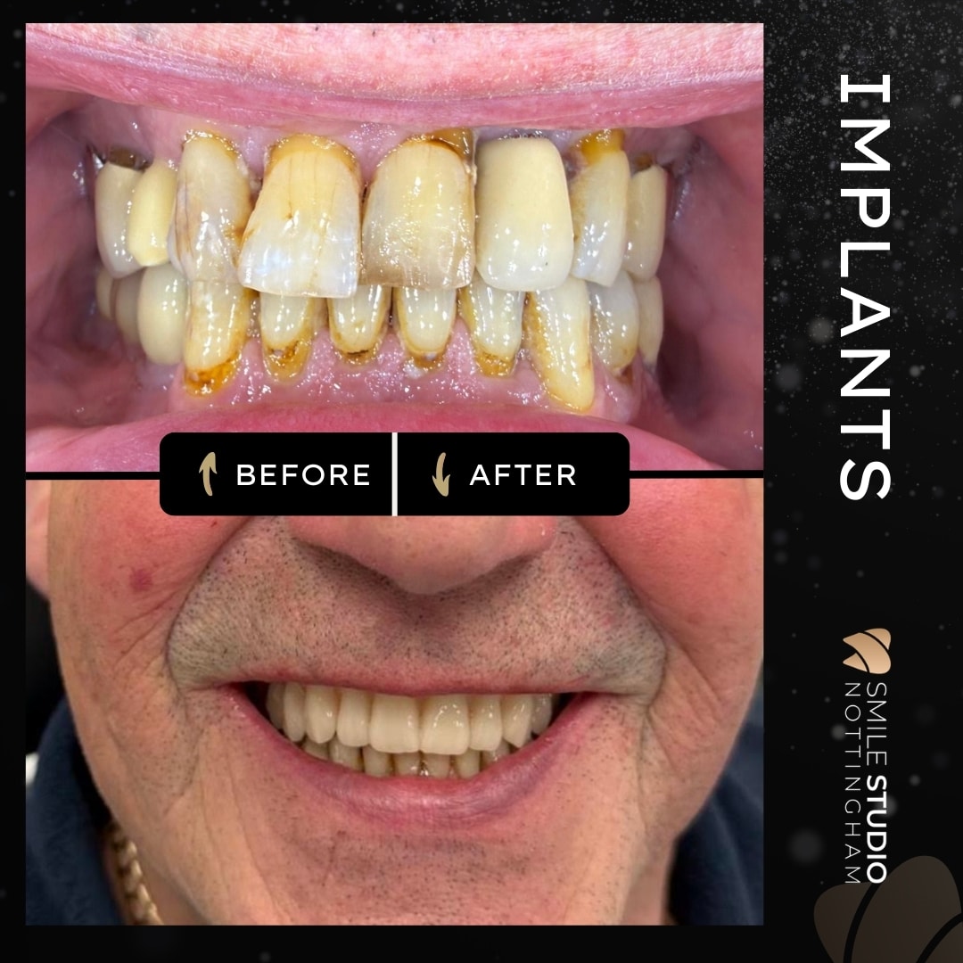 Dental implant all on four full mouth implants before and after nottingham