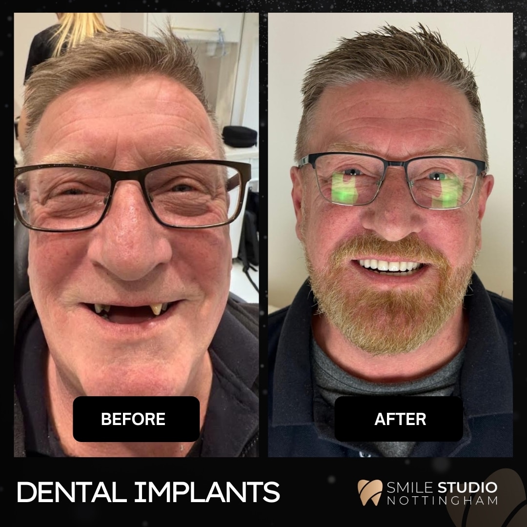 Dental implant all on four full mouth implants before and after nottingham