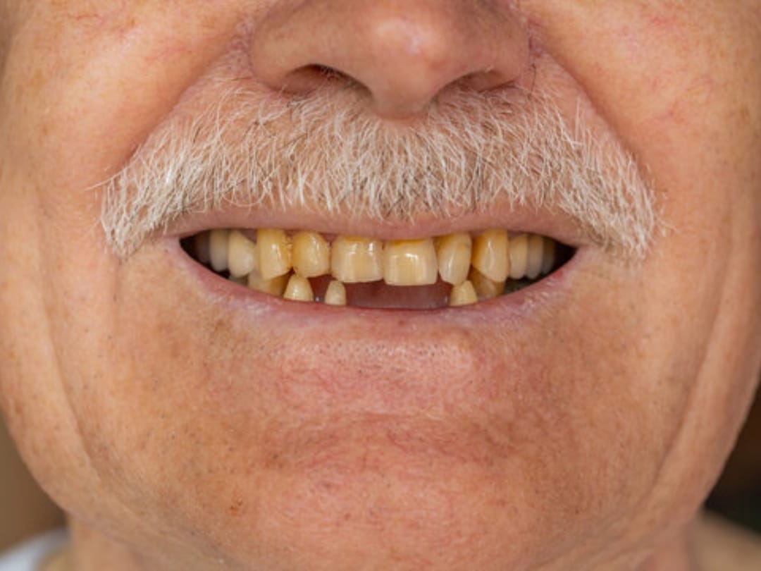 Missing or Broken Teeth