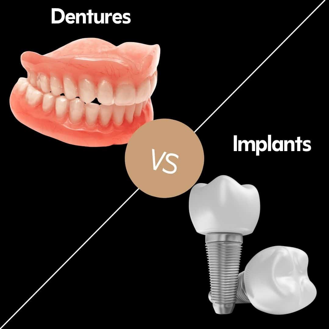 Comparison of dentures and dental implant options in Nottingham