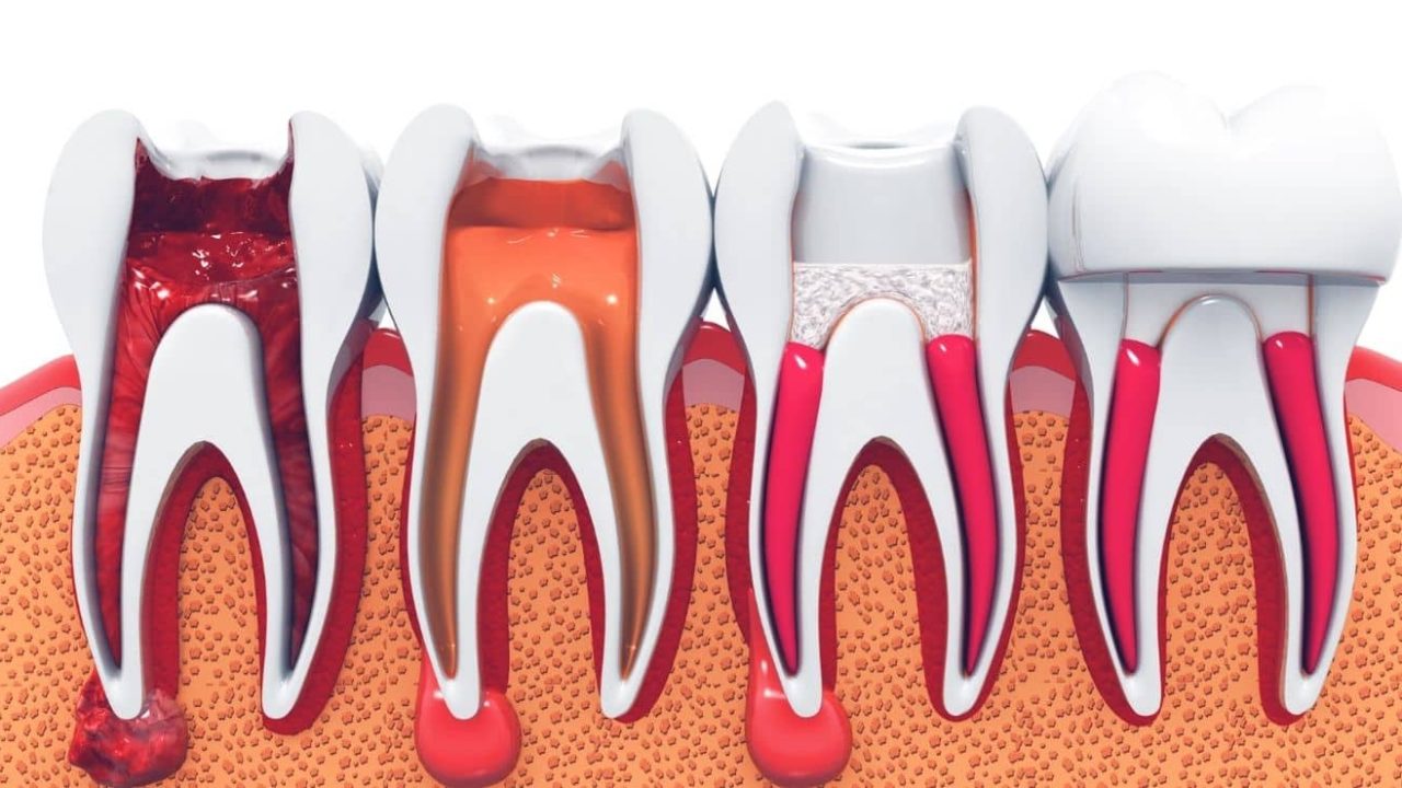 root canal in nottingham root canal in nottingham